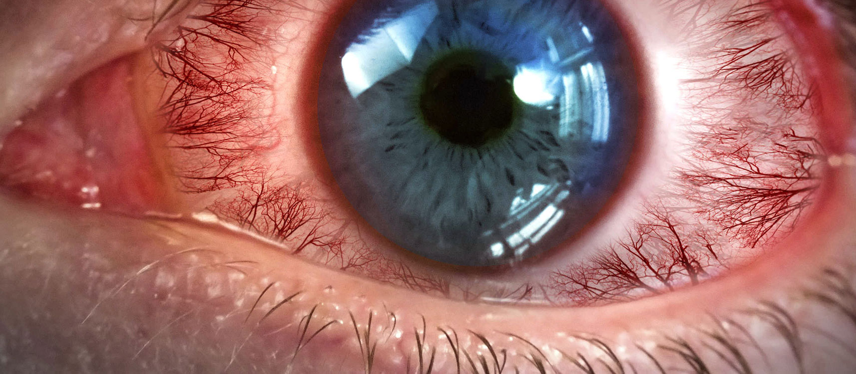 Seen here is a closeup of a wide-open blue-colored human eye that is very bloodshot red.